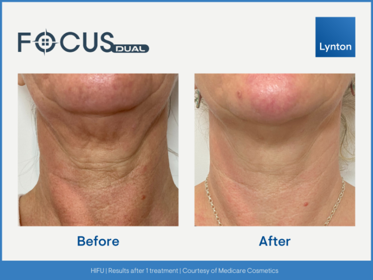 HIFU treatment westhoughton neck tightening