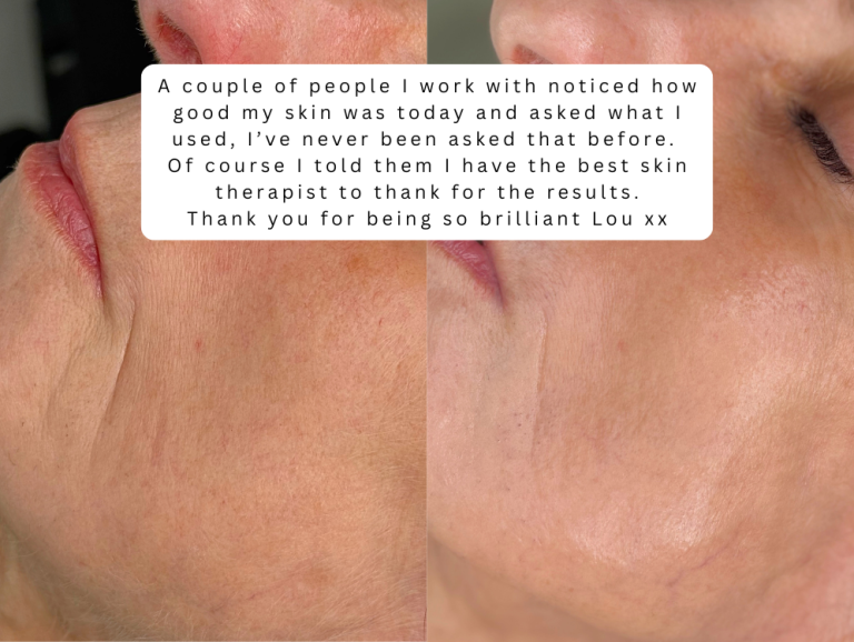 Polynucleotide skin treatment salmon sperm facial westhoughton