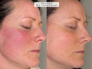 Rosacea treatment bolton redness skincare