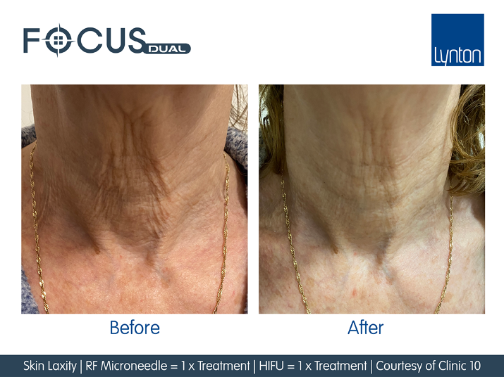 Skin Laxity on Neck tightening radio frequency microneedling