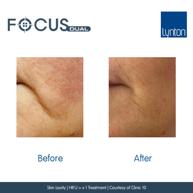 Skin laxity skin tightening jowl treatment sagging bolton marionette line treatment