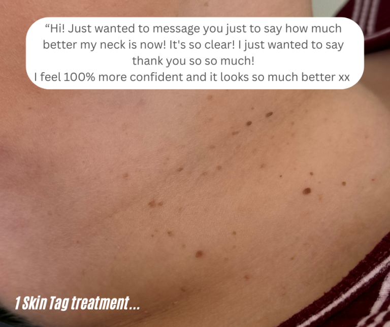 Can tiny Skin tags be removed?