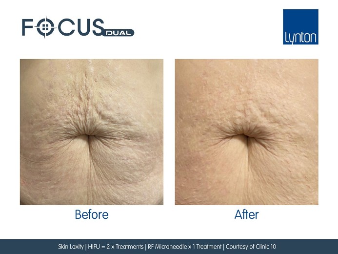 Stomach tightening bolton HIFU & RF Microneedling