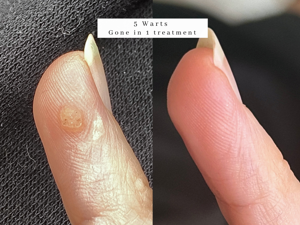 Hand Wart on finger treatment bolton