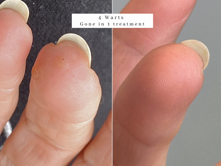 common Wart treatment on hands removed in 1 treatment westhoughton