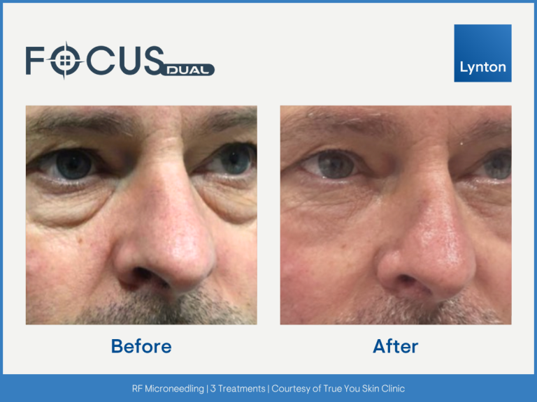 Westhoughton rf microneedling eye lift