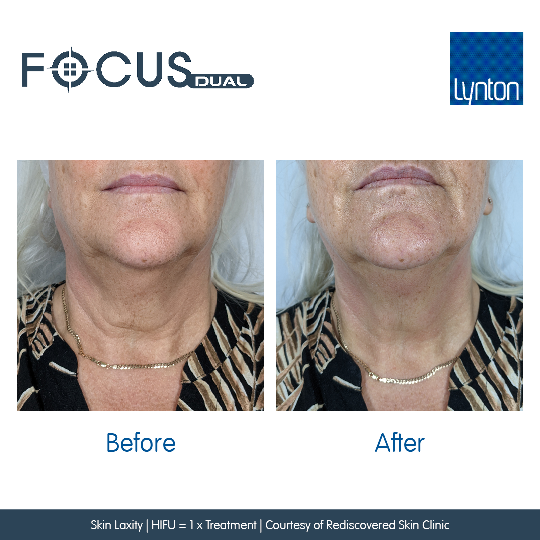 neck tightening sagging westhoughton lynton fucus dual