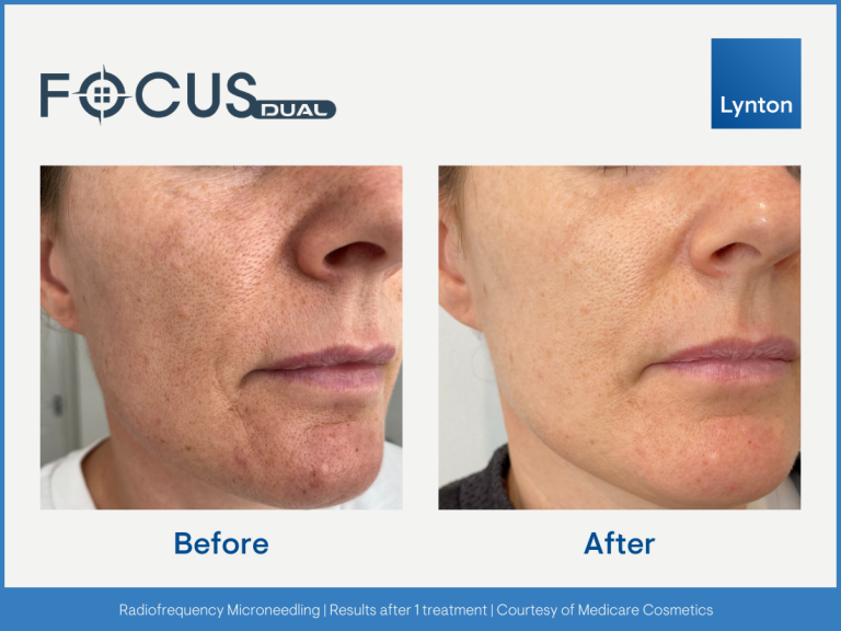 pore tightening treatment open pore bolton