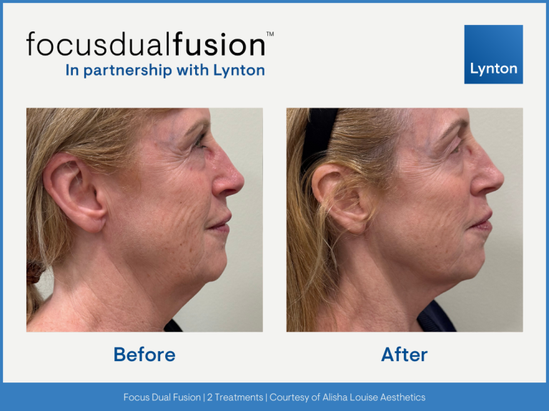 westhoughton focus dual fusion Lynton