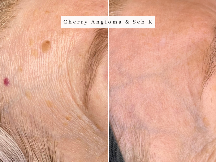 cherry angioma removal bolton