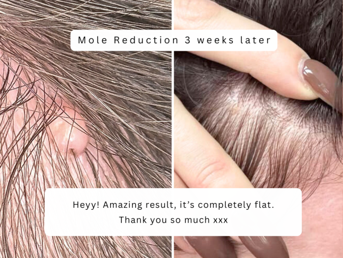 Mole check and removal bolton