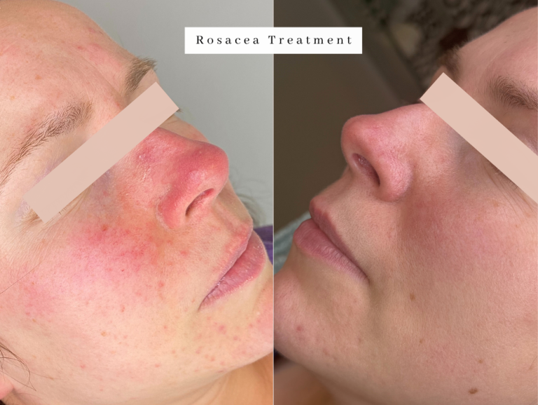 Rosacea treatment redness westhoughton