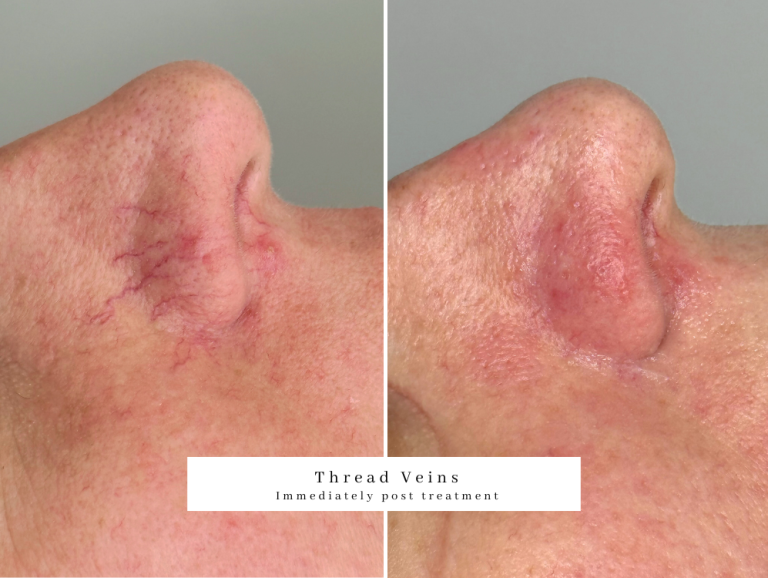 Lynton ipl vascular treatment bolton