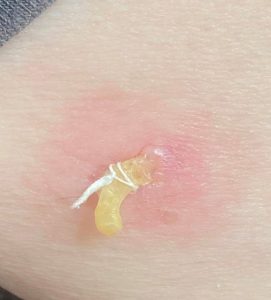 Lesion diagnosis westhoughton mole checks