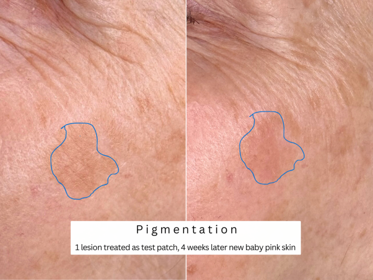 Pigmentation removal seborrheic keratosis treatment bolton