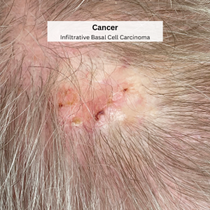 Skin check dermatology mole screening bolton Basal cell carcinoma BCC