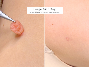 Skin tag removal clinic dermatologist bolton