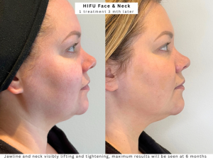 westhoughton HIFU treatment non surgical facelift lower face lift