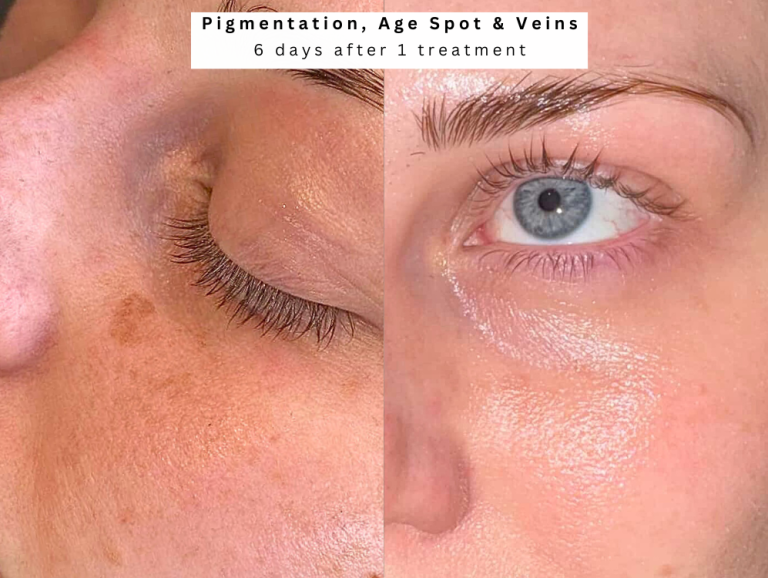 Age spot treatment bolton