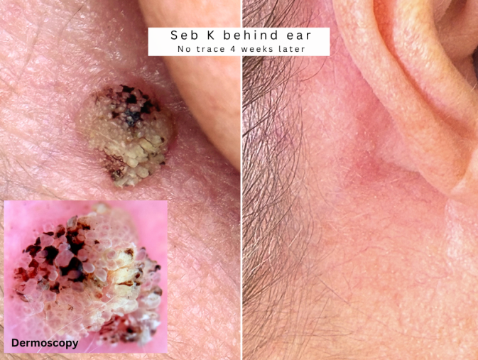 Seb k removal bolton