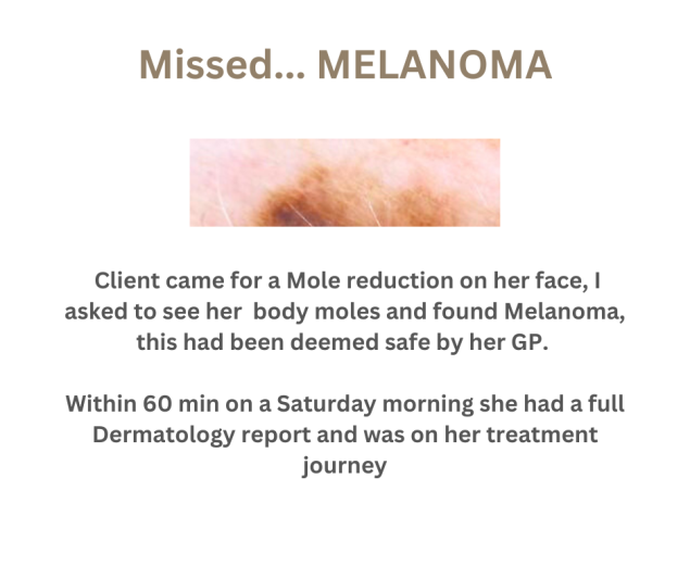 Skin Check bolton mole melanoma check