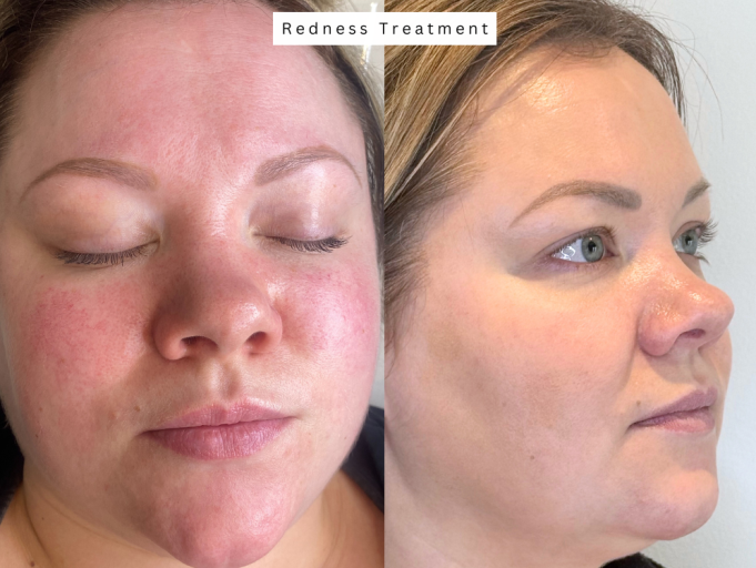 Skin resurfacing bolton redness treatment Rosacea skincare