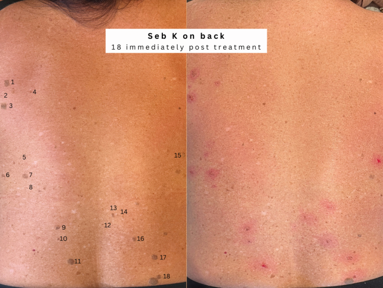 Geriatric Wart removal