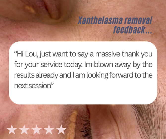 xanthelasma treatment review bolton