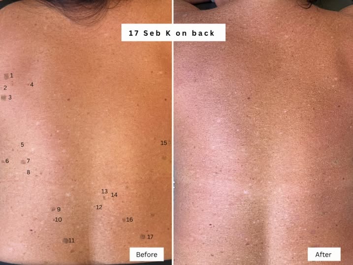 Skin check bolton wart removal back