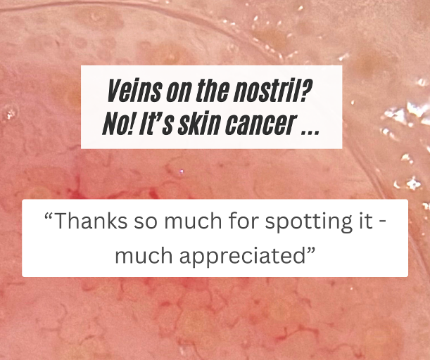 Mole Mapping bolton loud skin clinic review