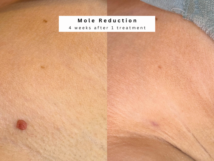Cosmetic mole treatment manchester