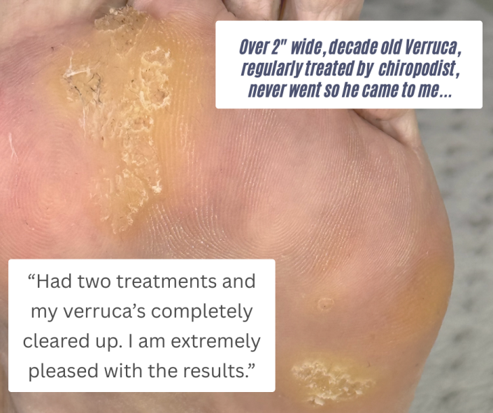 Verruca treatment bolton manchester removal