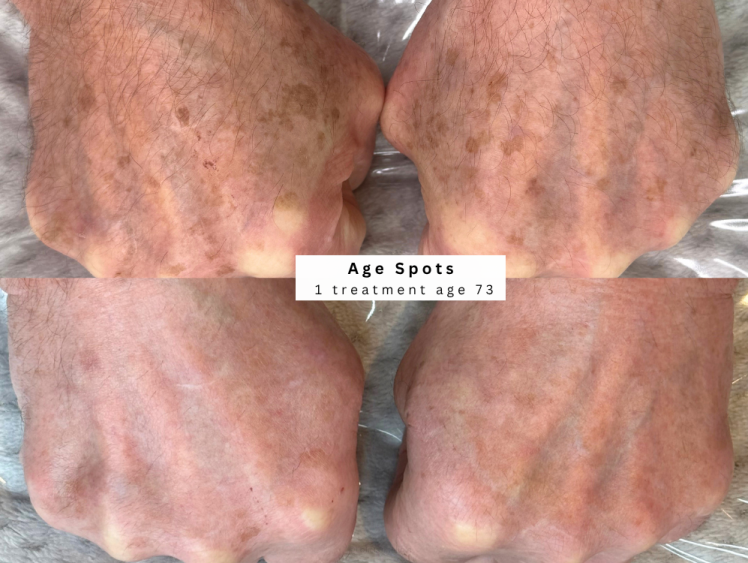 Age spot treatment hand pigmentation bolton