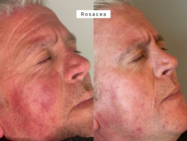 Rosacea Ipl treatment westhoughton