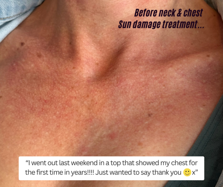 Chest sun damage treatment westhoughton pigmentation