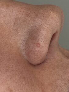 Fibrous Papule treatment westhoughton