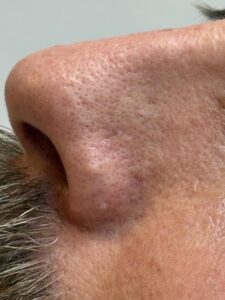 Fibrous papule removal westhoughton bumps on nose