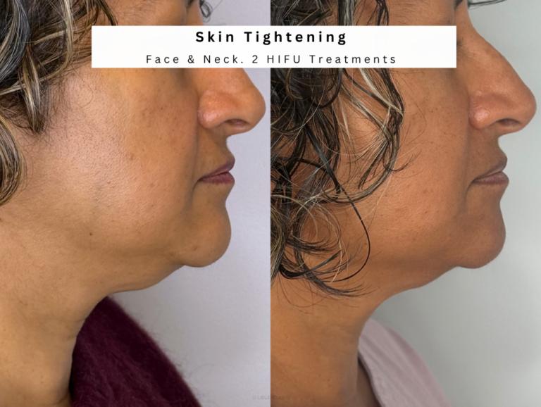 Skin tightening bolton Hifu saggy jowl treatment hifu neck tightening
