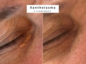 Xanthelasm Treatment bolton westhoughton lesion removal cholesterol deposits eyes