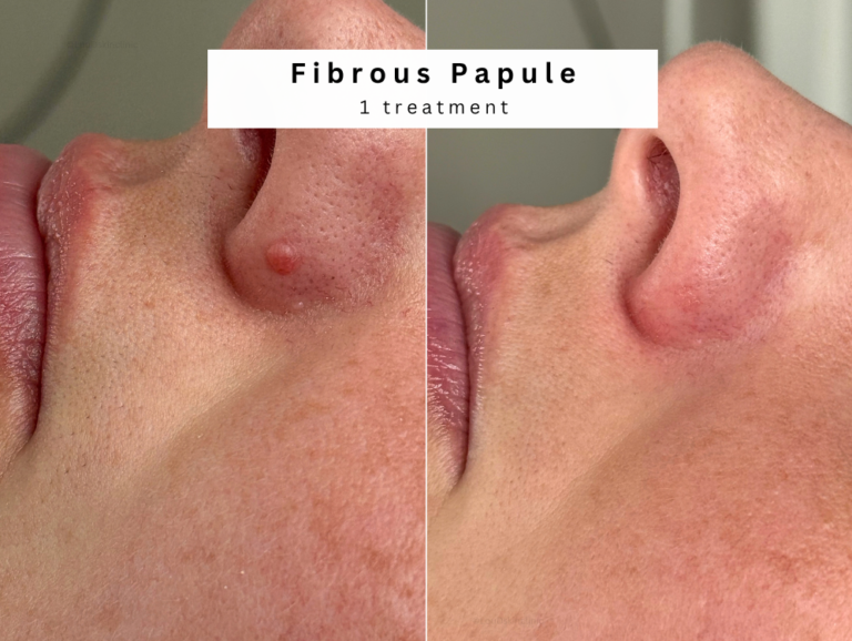 Best fibrous papule treatment in Bolton, manchester before and after