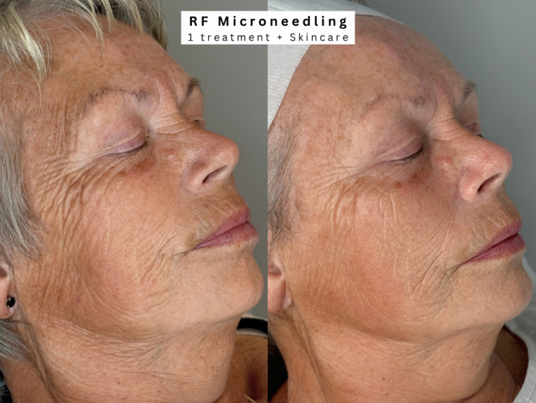 RF Microneedling westhoughton skin tightening treatment before and after