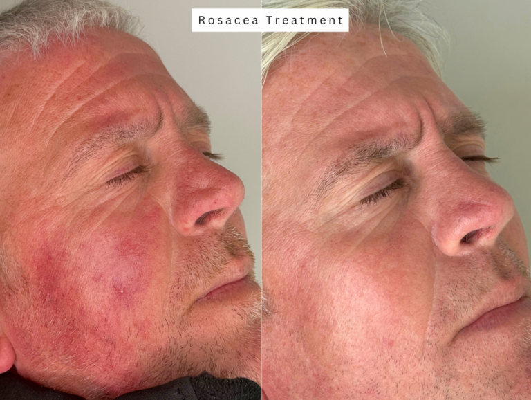 Rosacea skincare ipl vein treatment bolton