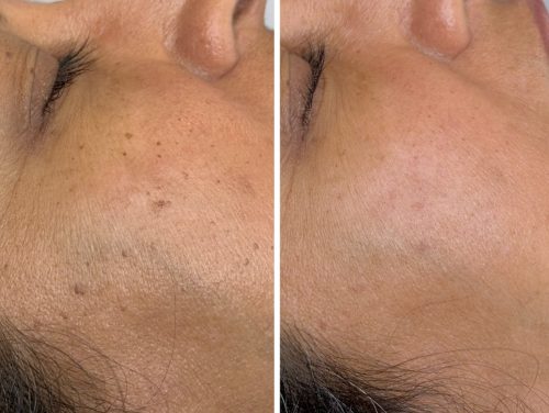Bolton dermatosis papulosa nigra dpn wethoughton Bolton dermatosis papulosa nigra dpn wethoughton