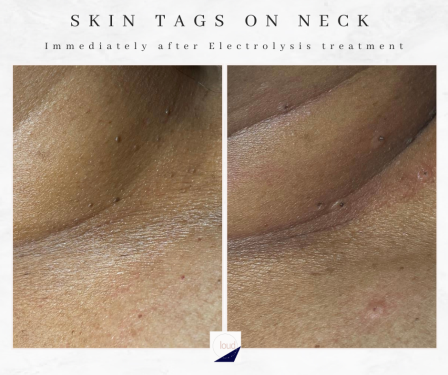 Skin Tag removal bolton