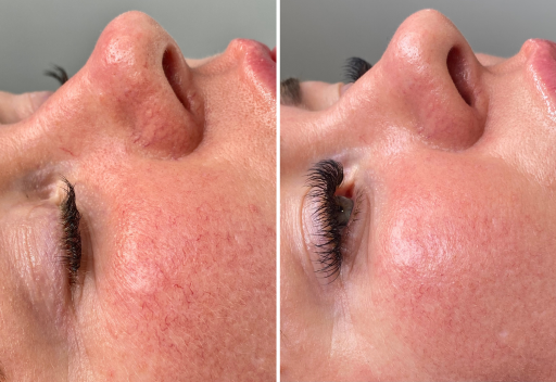 Thread vein removal - Spider Vein Removal - Bolton